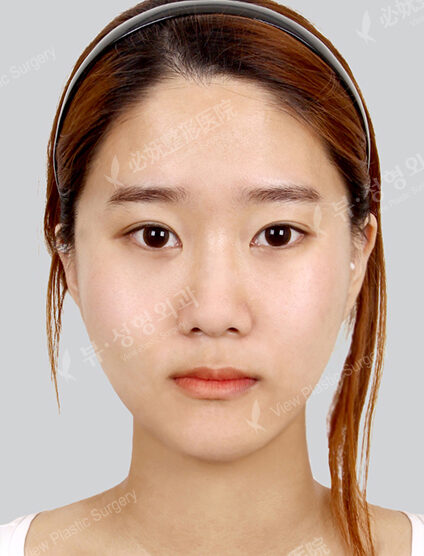 Natural Vline+Zygoma Reduction (4 Months) — After