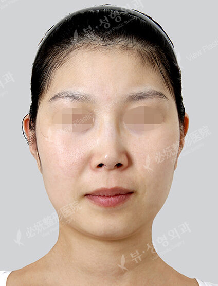 Natural Vline+Zygoma Reduction (3 Months) — Before