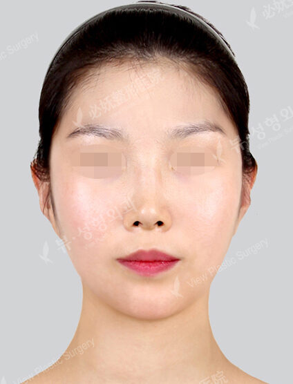 Natural Vline+Zygoma Reduction (3 Months) — After
