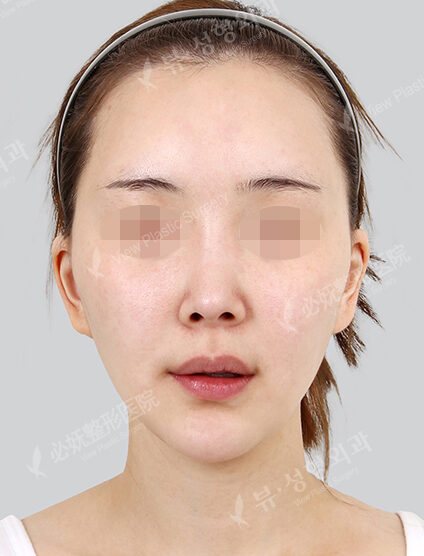 Zygoma Reduction (1 Months) — Before