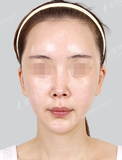 Zygoma Reduction (1 Months) — After