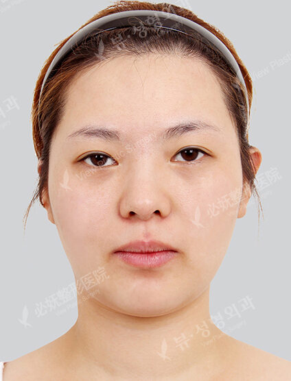 Natural Vline (Revisional Surgery)+ Zygoma Reduction+PA+Rhinoplasty (Revisional Surgery)(2 Months) — Before
