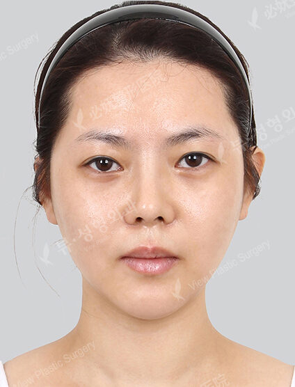 Natural Vline (Revisional Surgery)+ Zygoma Reduction+PA+Rhinoplasty (Revisional Surgery)(2 Months) — After