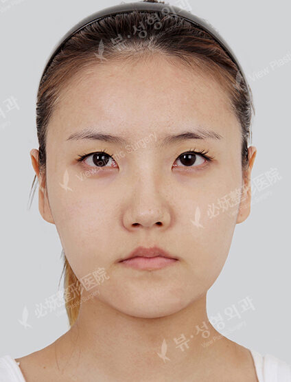 Natural Vline+Zygoma Reduction (1 Months) — Before
