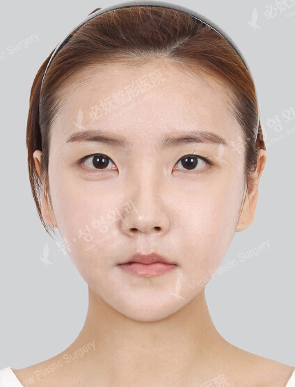 Natural Vline+Zygoma Reduction (1 Months) — After