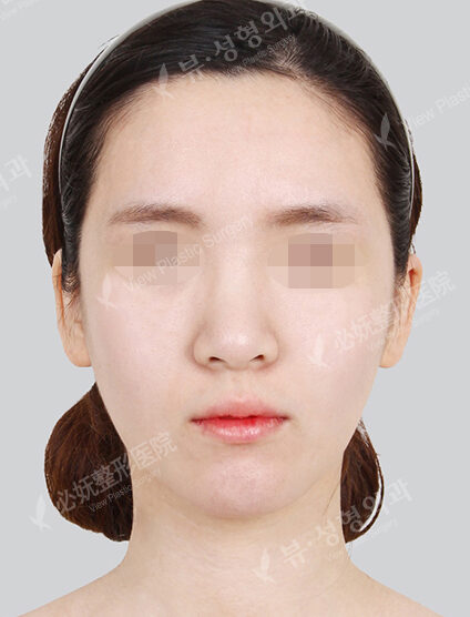 Angular Jaw Reduction (Revisional Surgery)+ Genioplasty (1 Months) — Before