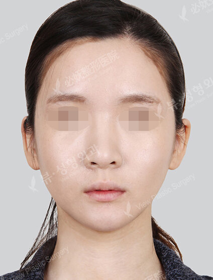 Angular Jaw Reduction (Revisional Surgery)+ Genioplasty (1 Months) — After