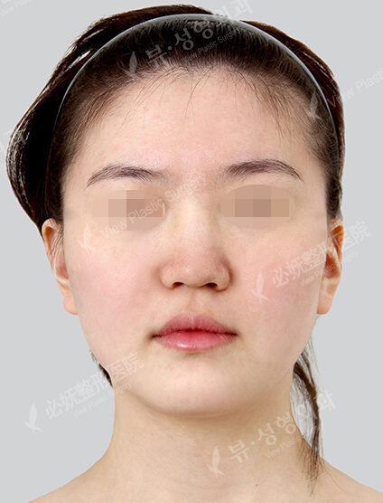 Natural Vline+Zygoma Reduction+PA+Rhinoplasty (1 Months) — Before