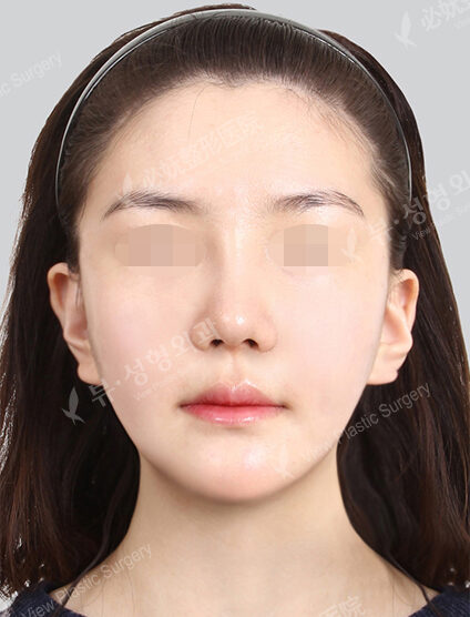 Natural Vline+Zygoma Reduction+PA+Rhinoplasty (1 Months) — After