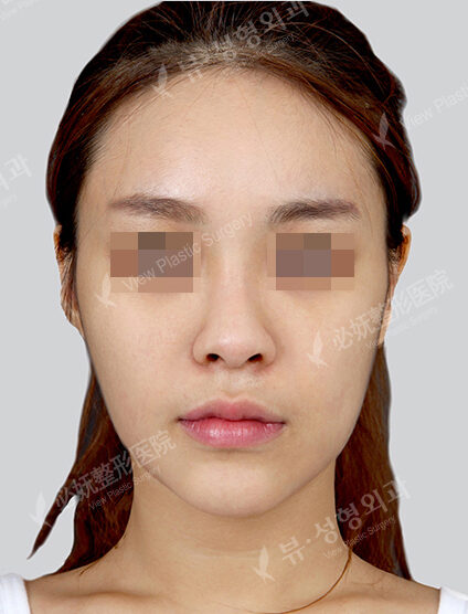 Natural Vline+Rhinoplasty (Revisional Surgery)(1 Months) — Before