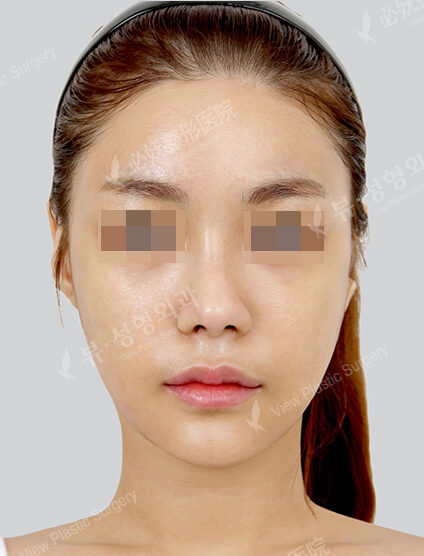 Natural Vline+Rhinoplasty (Revisional Surgery)(1 Months) — After