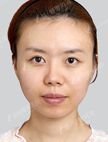 Natural Vline+Zygoma Reduction (2 Months) — Before