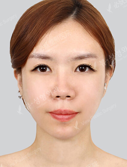 Natural Vline+Zygoma Reduction (2 Months) — After