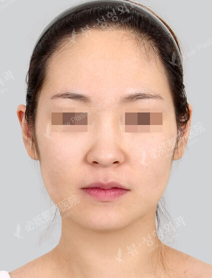 Natural Vline+Zygoma Reduction+PA+Forehead Implant+Rhinoplasty (1 Months) — Before