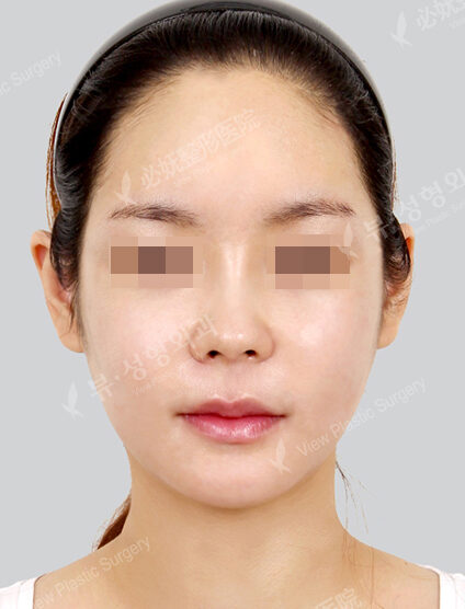 Natural Vline+Zygoma Reduction+PA+Forehead Implant+Rhinoplasty (1 Months) — After