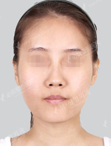 Natural Vline+Zygoma Reduction+Rhinoplasty (5 Months) — Before