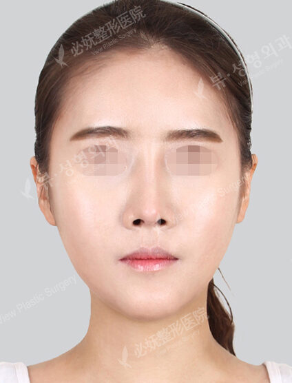 Natural Vline+Zygoma Reduction+Rhinoplasty (5 Months) — After