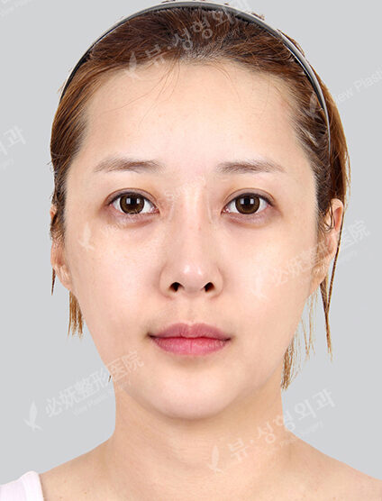 Natural Vline+Zygoma Reduction+Forehead Implant (4 Months) — Before