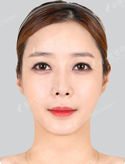 Natural Vline+Zygoma Reduction+Forehead Implant (4 Months) — After