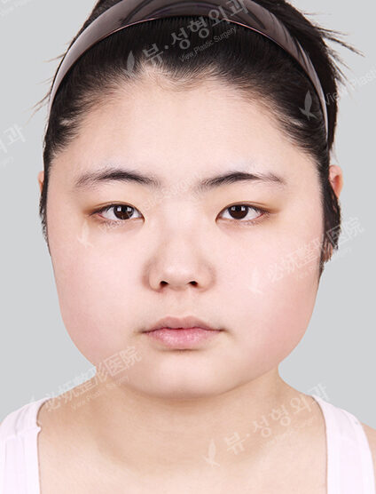 Natural Vline+Acculifting+Rhinoplasty (7 Months) — Before
