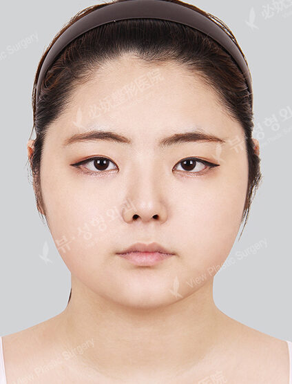 Natural Vline+Acculifting+Rhinoplasty (7 Months) — After