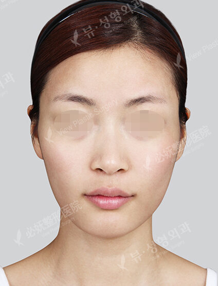 Natural Vline+Zygoma Reduction+Rhinoplasty+Frontal Cheek Implant+PA (7 Months) — Before