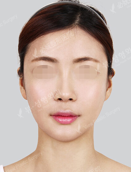 Natural Vline+Zygoma Reduction+Rhinoplasty+Frontal Cheek Implant+PA (7 Months) — After
