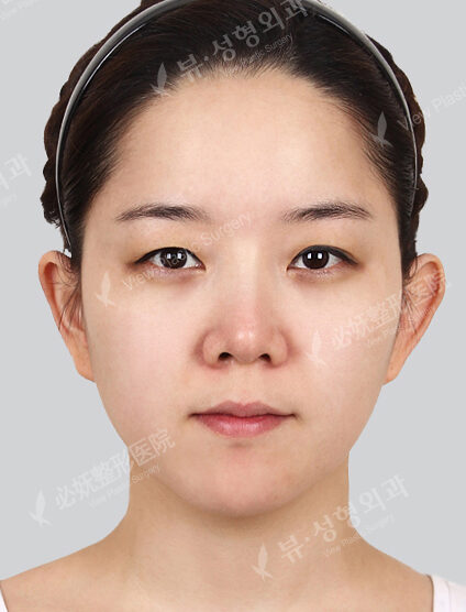 Doll Line (Vline)+ Zygoma Reduction+ Frontal Cheek Implant +Combination Ptosis Correction Surgery +Sub-Brow Lift (5 Months) — Before
