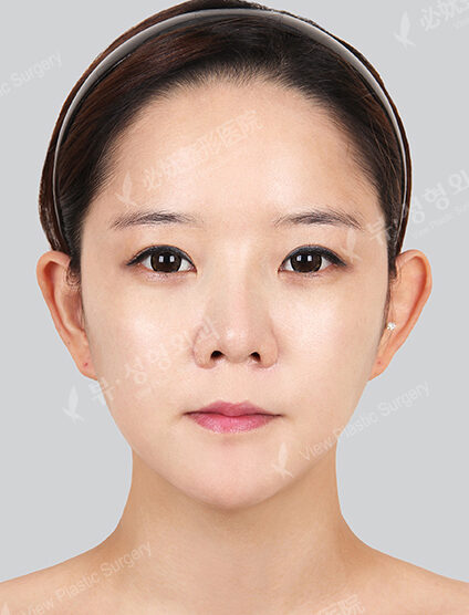Doll Line (Vline)+ Zygoma Reduction+ Frontal Cheek Implant +Combination Ptosis Correction Surgery +Sub-Brow Lift (5 Months) — After