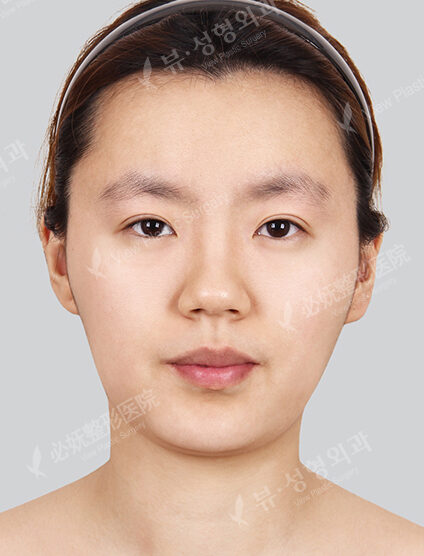 Natural Vline+Zygoma Reduction+Frontal Cheek Implant+Rhinoplasty (6 Months) — Before