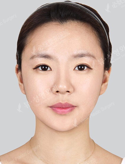 Natural Vline+Zygoma Reduction+Frontal Cheek Implant+Rhinoplasty (6 Months) — After
