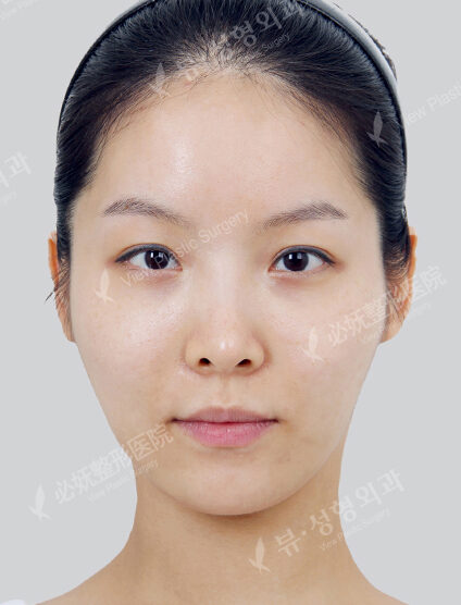 Doll Line (Vline)+ Zygoma Reduction (6 Months) — Before