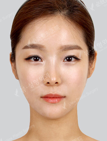 Doll Line (Vline)+ Zygoma Reduction (6 Months) — After