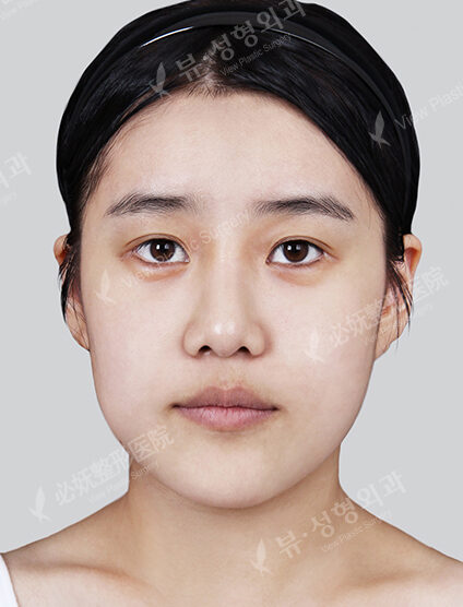 Doll Line (Vline)+ Zygoma Reduction+Revisional Rhinoplasty(6 Months) — Before