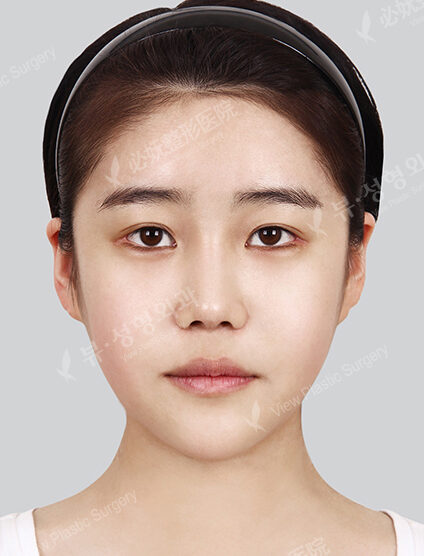 Doll Line (Vline)+ Zygoma Reduction+Revisional Rhinoplasty(6 Months) — After