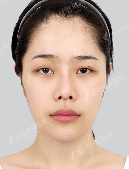 Natural Vline+Zygoma Reduction+Fat Graft+Combination Ptosis Correction Surgery+Rhinoplasty (9 Months) — Before