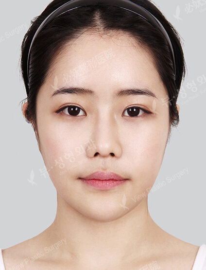 Natural Vline+Zygoma Reduction+Fat Graft+Combination Ptosis Correction Surgery+Rhinoplasty (9 Months) — After
