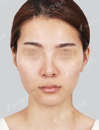 Angular Jaw Reduction+Zygoma Reduction (3 Months) — Before