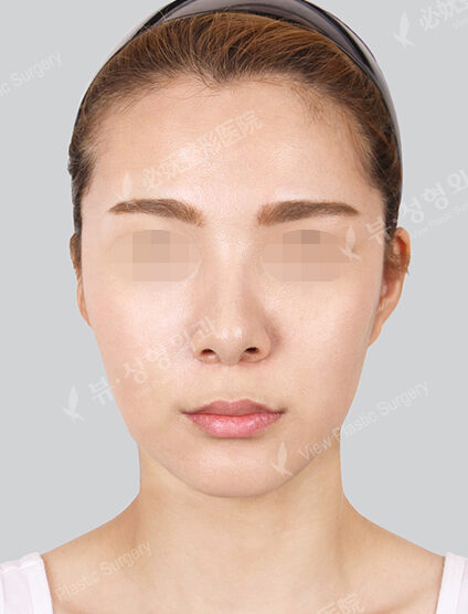 Angular Jaw Reduction+Zygoma Reduction (3 Months) — After