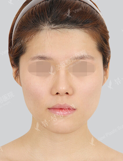 Angular Jaw Reduction+Genioplasty(12 Months) — Before
