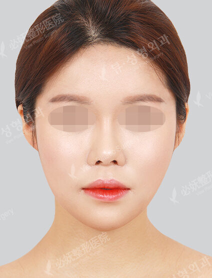 Angular Jaw Reduction+Genioplasty(12 Months) — After