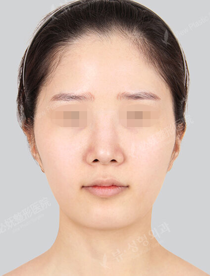 Natural Vline+Zygoma Reduction+Forehead Fat Graft (3 Months) — Before