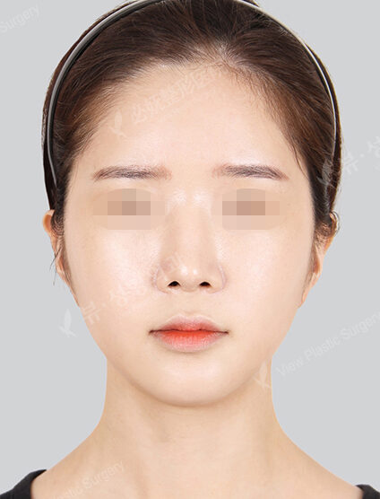 Natural Vline+Zygoma Reduction+Forehead Fat Graft (3 Months) — After