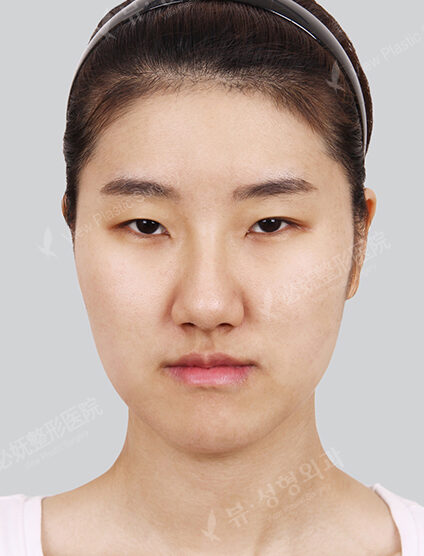 Natural Vline+Zygoma Reduction+Rhinoplasty+Combination Ptosis Correction Surgery (9 Months) — Before