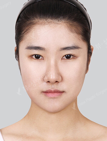 Natural Vline+Zygoma Reduction+Rhinoplasty+Combination Ptosis Correction Surgery (9 Months) — After