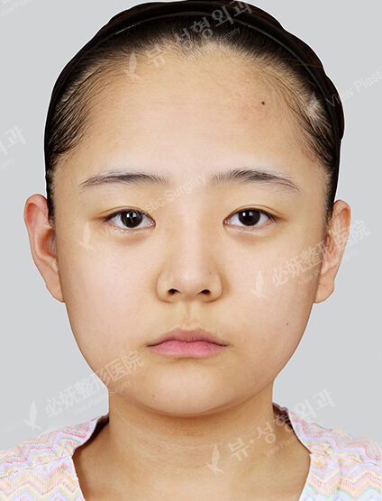 Natural Vline+Lateral Canthoplasty+Lower Canthoplasty (13 Months) — Before