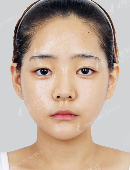 Natural Vline+Lateral Canthoplasty+Lower Canthoplasty (13 Months) — After