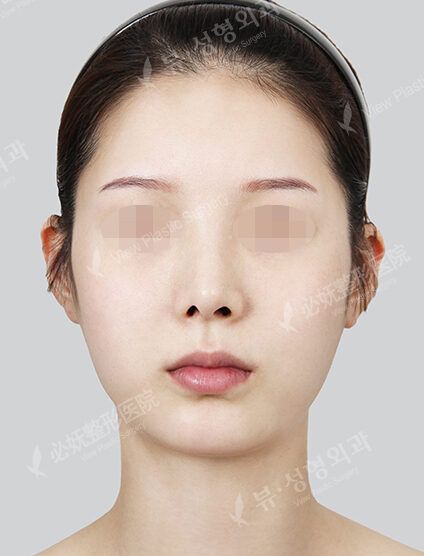 Natural Vline+Zygoma Reduction+Forehead Implant (1 Months) — Before