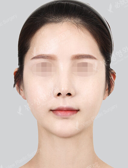 Natural Vline+Zygoma Reduction+Forehead Implant (1 Months) — After