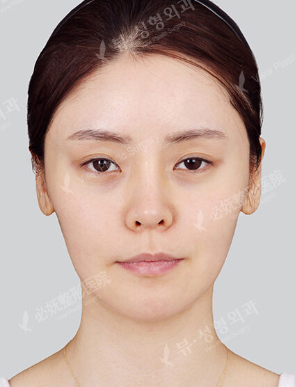 Zygoma Reduction (12 Months) — Before